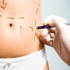 liposuccion en hombres y mujeres, cirugia plastica